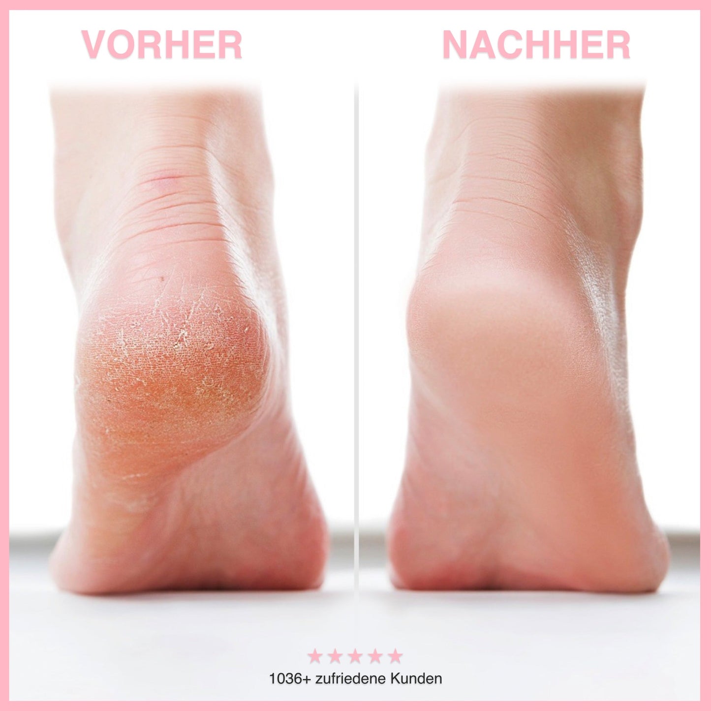 Electric Callus Remover