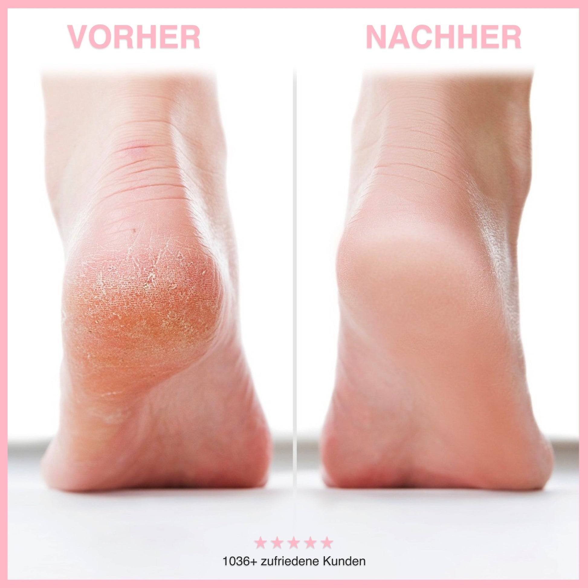 Electric Callus Remover