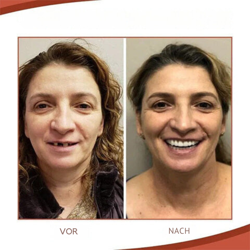 FleekFit | Biocompatible Prosthesis Set for Pain-Free Fit and Natural Smile