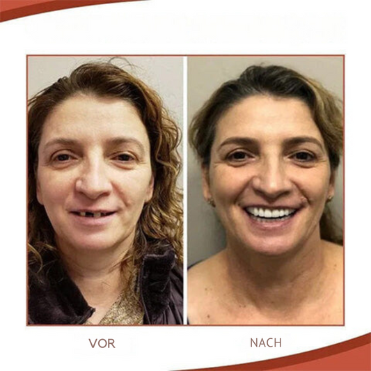 FleekFit | Biocompatible Prosthesis Set for Pain-Free Fit and Natural Smile