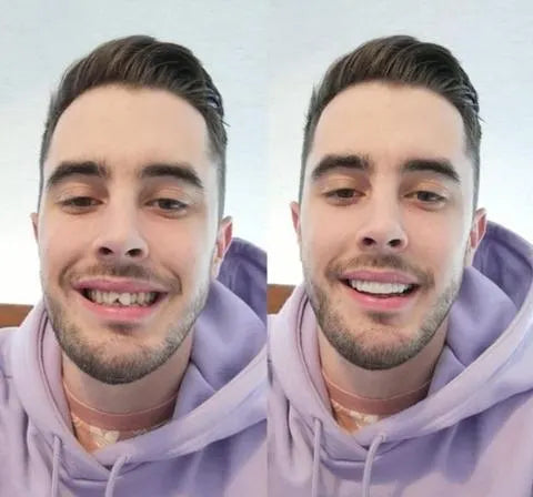 FleekFit | On Smile Veneers (Upper and Lower Jaw included)