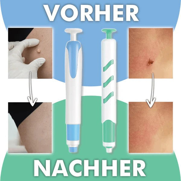 FleekFit Wart-Free PRO - The Professional Wart Remover
