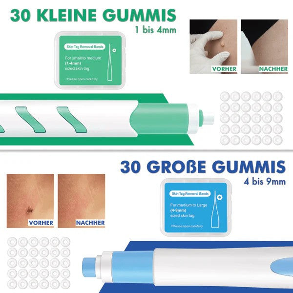 FleekFit Wart-Free PRO - The Professional Wart Remover