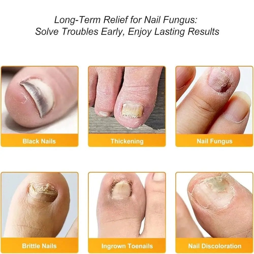 FungalPatch - Antibacterial Fungal Infection Patches and Nail Care Pack