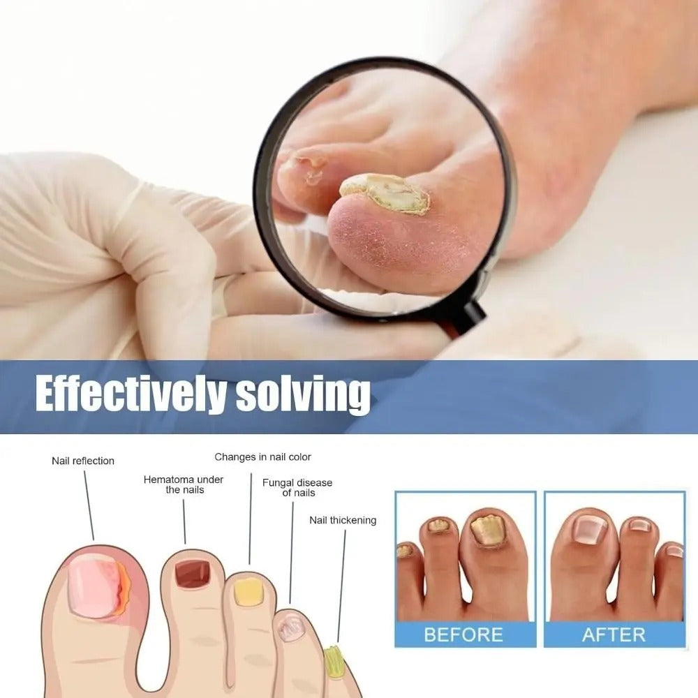 FungalPatch - Antibacterial Fungal Infection Patches and Nail Care Pack