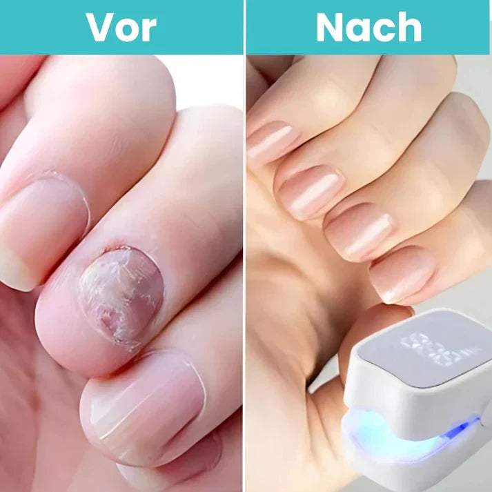 MycoCare™ - Laser Nail Fungus Treatment Device