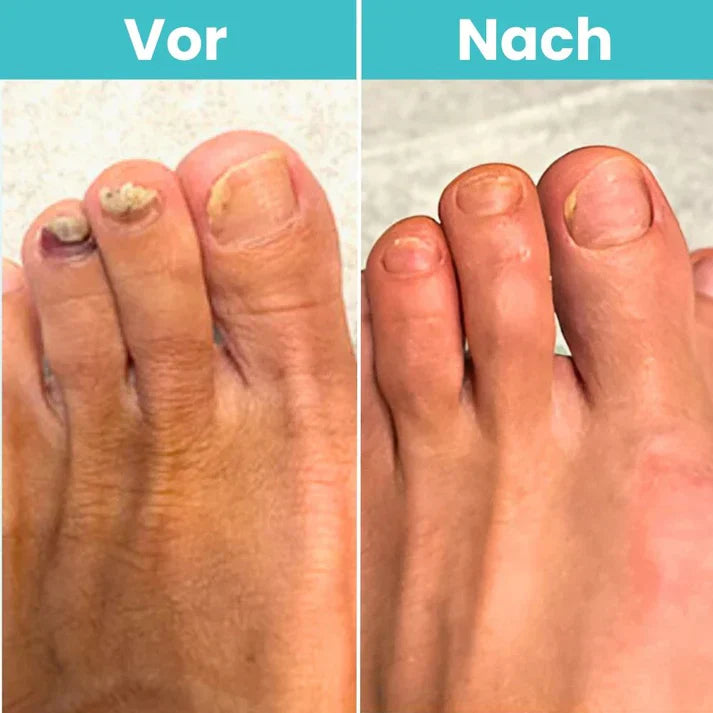 MycoCare™ - Laser Nail Fungus Treatment Device