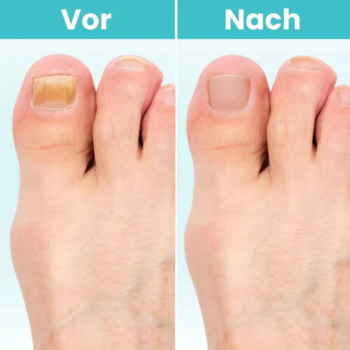 MycoCare™ - Laser Nail Fungus Treatment Device