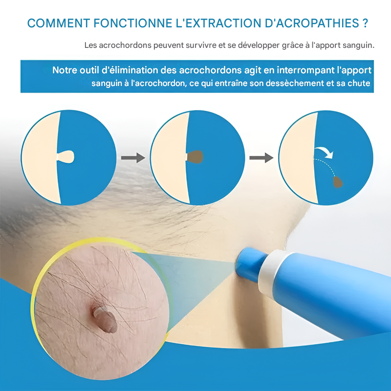 Wart Removal Kit - Simple Cryotherapy